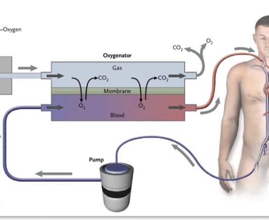 Understanding Extracorporeal Membrane Oxygenation (ECMO) Program Banner