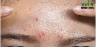 Understanding Petechiae Banner